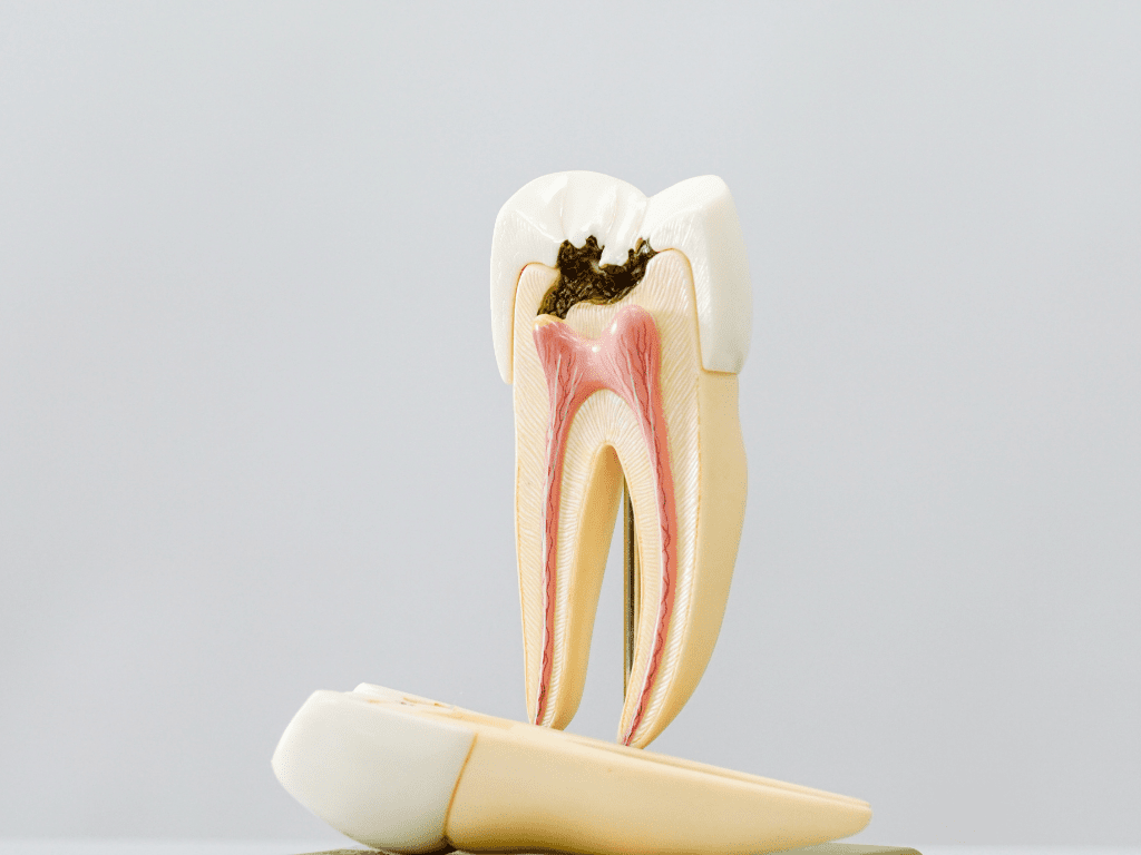 replica dinte sparta pe jumatate cu carie dentara