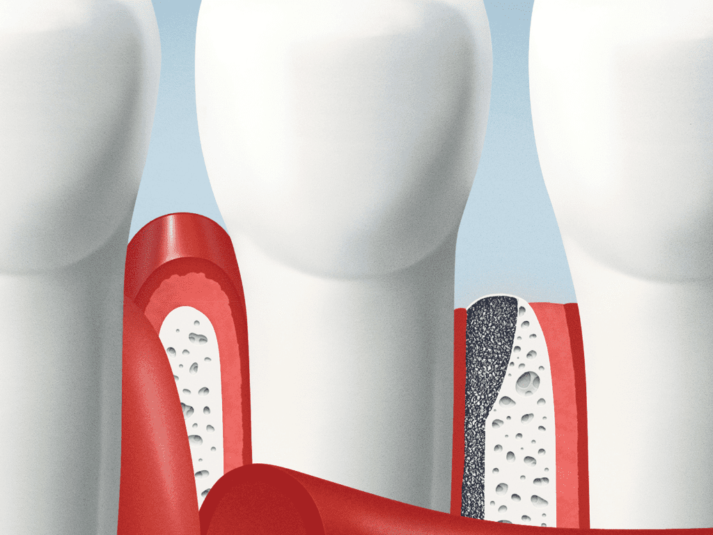 grafic cu dinti, gingii si tartrul care apare sub gingie